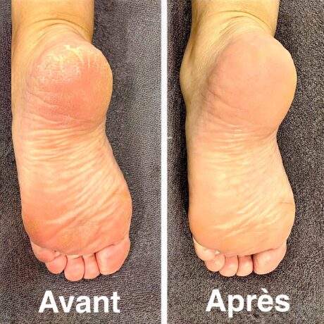 callus